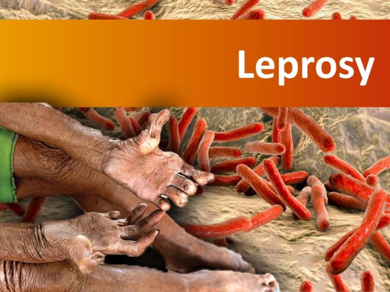 Leprosy