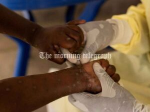 First Case of More Dangerous Mpox Found Outside Africa